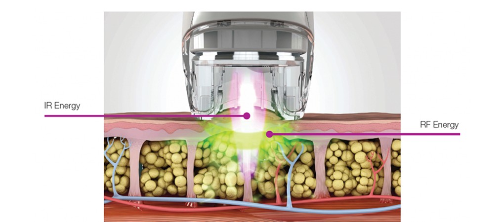 Velashape V-Shape III Pro (1)